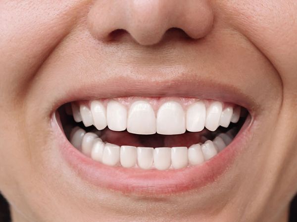 After orthodontic treatment